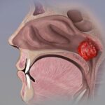 Adenoid Enlargement