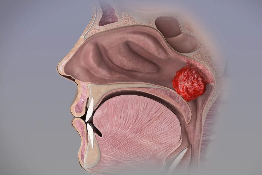 Adenoid Enlargement