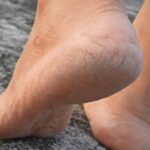 Cracked Heels Remedy