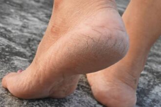 Cracked Heels Remedy