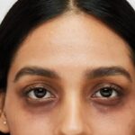 Dark Circles