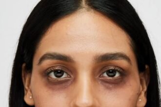 Dark Circles