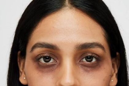 Dark Circles