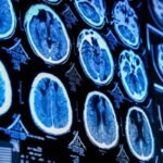 Brain Tumor Research