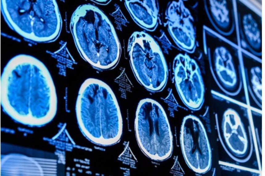 Brain Tumor Research