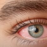 Conjunctivitis