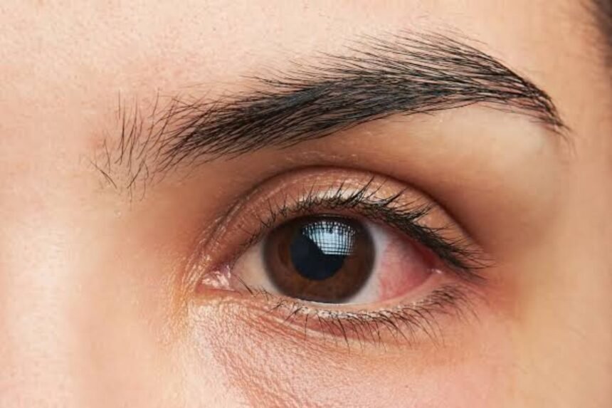 Eye Makeup Infection