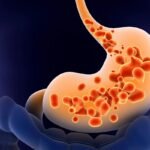 Gastroesophageal Reflux Disease