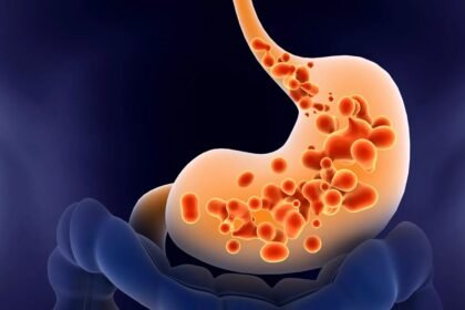 Gastroesophageal Reflux Disease